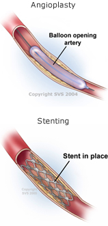 angioplasty_stenting