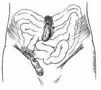 Illustration of intestines protruding through a hernia.