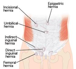 Illustration showing type of hernias.